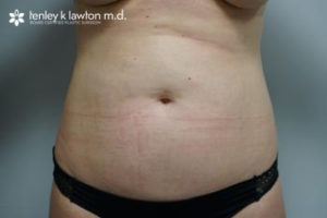 Liposuction Newport Beach