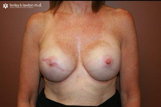 Breast Reconstruction Newport Beach