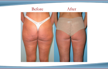 Is Liposuction My Only Option for Body Contouring?, Liposuction Newport  Beach