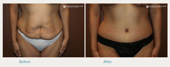 https://www.lawtonmd.com/wp-content/uploads/2020/09/Tummy-Tuck-Cost-Huntington-Beach-1.png
