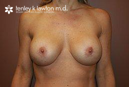Breast Implant Removal & Replacement Newport Beach
