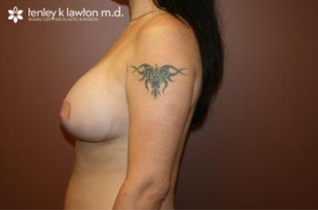 Breast Augmentation Newport Beach