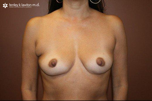 Breast Augmentation Newport Beach