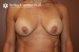 Breast Implant Removal & Replacement Newport Beach