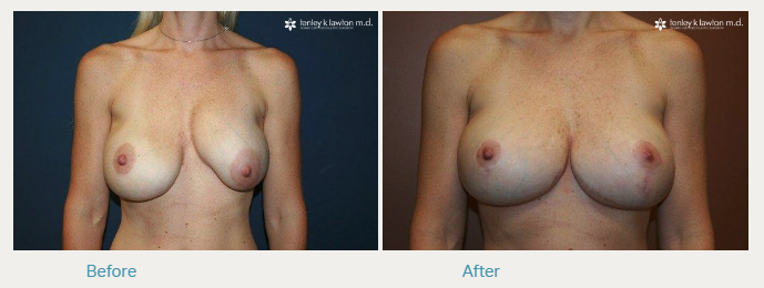 Breast Implant Newport Beach
