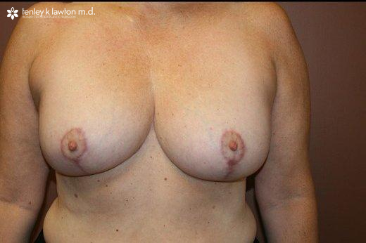 Breast Reduction Newport Beach