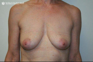 Breast Reconstruction Newport Beach