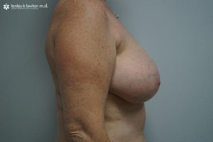 Breast Reduction Newport Beach